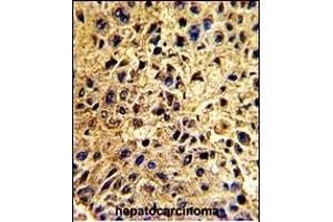 Formalin-fixed and paraffin-embedded human hepatocarcinoma with NUP62 Antibody (C-term ), which was peroxidase-conjugated to the secondary antibody, followed by DAB staining. (NUP62 抗体  (C-Term))