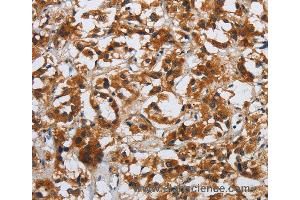 Immunohistochemistry of Human esophagus cancer using DSP Polyclonal Antibody at dilution of 1:40