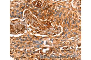 Immunohistochemistry of Human esophagus cancer using LGALS1 Polyclonal Antibody at dilution of 1:25 (LGALS1/Galectin 1 抗体)
