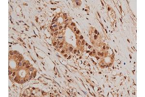 ABIN6269405 at 1/50 staining human colon cancer tissue sections by IHC-P. (HDAC5 抗体)