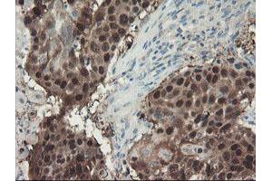 Immunohistochemical staining of paraffin-embedded Carcinoma of Human lung tissue using anti-ADH7 mouse monoclonal antibody. (ADH7 抗体)