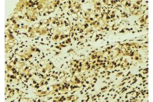 ABIN6276713 at 1/100 staining Human breast cancer tissue by IHC-P. (CDK6 抗体  (N-Term))