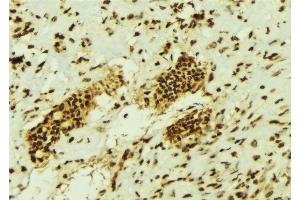 ABIN6274457 at 1/100 staining Human breast cancer tissue by IHC-P. (EZH1 抗体  (Internal Region))