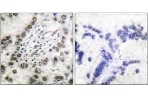 Immunohistochemistry analysis of paraffin-embedded human lung carcinoma tissue, using CBP (Ab-1535) Antibody. (CBP 抗体  (AA 1501-1550))