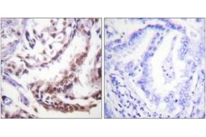 Immunohistochemistry analysis of paraffin-embedded human lung carcinoma tissue, using Histone H3 (Acetyl-Lys9) Antibody. (Histone 3 抗体  (H3K9ac))