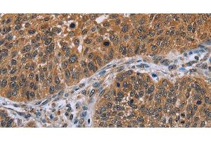 Immunohistochemistry of paraffin-embedded Human lung cancer tissue using IHH Polyclonal Antibody at dilution 1:30 (Indian Hedgehog 抗体)