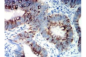 Immunohistochemical analysis of paraffin-embedded colon cancer tissues using KRT20 mouse mAb with DAB staining. (KRT20 抗体  (AA 1-150))