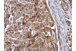 IHC-P Image Cullin 7 antibody [C2C3], C-term detects Cullin 7 protein at cytoplasm in human cervical carcinoma by immunohistochemical analysis. (Cullin 7 抗体  (C-Term))