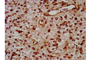 IHC image of ABIN7172127 diluted at 1:400 and staining in paraffin-embedded human glioma performed on a Leica BondTM system. (TOX 抗体  (AA 141-288))