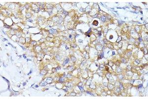 Immunohistochemistry of paraffin-embedded Human mammary cancer using EIF3L Polyclonal Antibody at dilution of 1:100 (40x lens). (EIF3L 抗体)