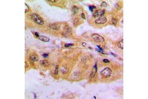 Immunohistochemical analysis of SMAD2 (pS467) staining in human lung cancer formalin fixed paraffin embedded tissue section.
