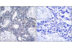 Immunohistochemistry analysis of paraffin-embedded human breast carcinoma tissue, using ZAP-70 (Ab-493) Antibody. (ZAP70 抗体  (AA 460-509))