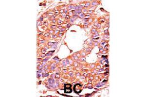 Formalin-fixed and paraffin-embedded human breast cancer tissue reacted with PPP6C polyclonal antibody  , which was peroxidase-conjugated to the secondary antibody, followed by AEC staining. (PPP6C 抗体  (N-Term))