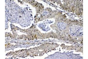 IHC testing of FFPE human colon cancer tissue with MED9 antibody at 1ug/ml. (MED9 抗体)