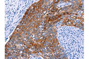 The image on the left is immunohistochemistry of paraffin-embedded Human cervical cancer tissue using ABIN7192345(SGK2 Antibody) at dilution 1/20, on the right is treated with synthetic peptide. (SGK2 抗体)