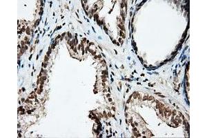 Immunohistochemical staining of paraffin-embedded Carcinoma of liver tissue using anti-PTPRE mouse monoclonal antibody. (PTPRE 抗体)