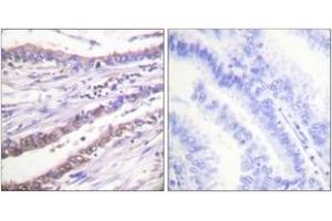 Immunohistochemistry analysis of paraffin-embedded human lung carcinoma tissue, using Cyclin A Antibody. (Cyclin A 抗体  (AA 221-270))