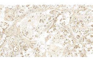 Detection of GAL3 in Human Lung cancer Tissue using Monoclonal Antibody to Galectin 3 (GAL3) (Galectin 3 抗体  (AA 1-250))
