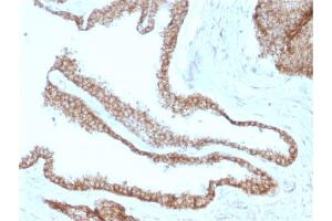 Formalin-fixed, paraffin-embedded human Prostate Carcinoma stained with Catenin, gamma Mouse Monoclonal Antibody (CTNG/1664) (JUP 抗体)