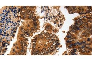 Immunohistochemistry of paraffin-embedded Human colon cancer using ADAP1 Polyclonal Antibody at dilution of 1:60 (ADAP1 抗体)