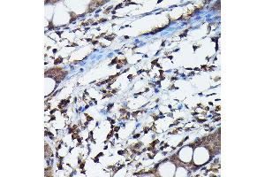 Immunohistochemistry of paraffin-embedded human colon using G Rabbit pAb (ABIN6129931, ABIN6137010, ABIN6137011 and ABIN6217659) at dilution of 1:100 (40x lens). (APOBEC3G 抗体  (AA 60-330))