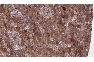 ABIN6277373 at 1/100 staining Human liver cancer tissue by IHC-P. (Connexin 31 抗体  (C-Term))