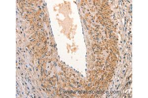 Immunohistochemistry of Human cervical cancer using ARFRP1 Polyclonal Antibody at dilution of 1:25 (ARFRP1 抗体)