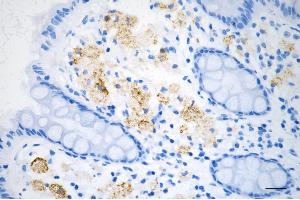Immunohistochemistry was performed on paraffin-embedded human sigmoid colon carcinoma using JNK1 antibody (ABIN7799457), 1:200).