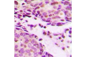 Immunohistochemical analysis of Histone H2B (AcK12) staining in human breast cancer formalin fixed paraffin embedded tissue section. (Histone H2B 抗体  (acLys12, N-Term))