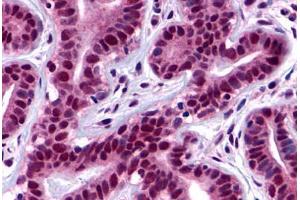 Human Ductal and Lobular Epithelium (formalin-fixed, paraffin-embedded) stained with PTK2 antibody ABIN213433 at 2 ug/ml followed by biotinylated goat anti-rabbit IgG secondary antibody ABIN481713, alkaline phosphatase-streptavidin and chromogen. (FAK 抗体  (Internal Region))