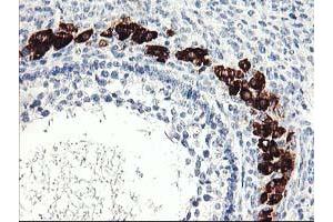 Immunohistochemical staining of paraffin-embedded Adenocarcinoma of Human ovary tissue using anti-PTPN7 mouse monoclonal antibody. (PTPN7 抗体)