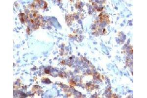 IHC testing of human gastric carcinoma stained with MUC5AC antibody (45M1). (MUC5AC 抗体)