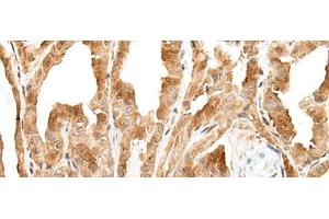 Immunohistochemistry of paraffin-embedded Human thyroid cancer tissue using ZPBP Polyclonal Antibody at dilution of 1:30(x200) (ZPBP 抗体)