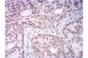 Immunohistochemical analysis of paraffin-embedded cervical cancer tissues using KDM1A mouse mAb with DAB staining.