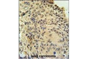 RSPO2 Antibody (C-term) (ABIN651457 and ABIN2840250) immunohistochemistry analysis in formalin fixed and paraffin embedded human lung carcinoma followed by peroxidase conjugation of the secondary antibody and DAB staining. (RSPO2 抗体  (C-Term))