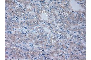 Immunohistochemical staining of paraffin-embedded Carcinoma of thyroid tissue using anti-NRBP1mouse monoclonal antibody.