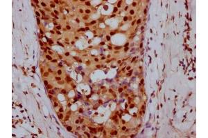 IHC image of ABIN7127442 diluted at 1:100 and staining in paraffin-embedded human breast cancer performed on a Leica BondTM system. (Recombinant Cyclin E1 抗体)