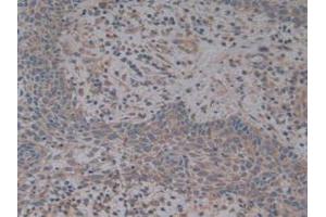 Detection of CFH in Human Skin Cancer Tissue using Polyclonal Antibody to Complement Factor H (CFH) (Complement Factor H 抗体  (AA 860-1231))