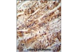 ZC3H15 antibody (C-term) (ABIN654819 and ABIN2844492) immunohistochemistry analysis in formalin fixed and paraffin embedded human colon carcinoma followed by peroxidase conjugation of the secondary antibody and DAB staining. (ZC3H15 抗体  (C-Term))
