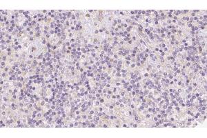 ABIN6273094 at 1/100 staining Human lymph cancer tissue by IHC-P. (BCO2 抗体  (Internal Region))