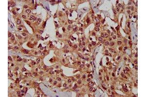 IHC image of ABIN7146680 diluted at 1:300 and staining in paraffin-embedded human liver cancer performed on a Leica BondTM system.