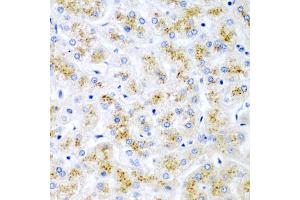 Immunohistochemistry of paraffin-embedded human liver injury using WNT2 antibody (ABIN5973475) at dilution of 1/200 (40x lens). (WNT2 抗体)