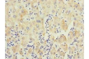 Immunohistochemistry of paraffin-embedded human liver cancer using ABIN7174120 at dilution of 1:100 (PTPN7 抗体  (AA 1-190))
