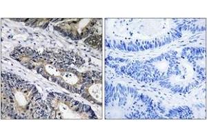 Immunohistochemistry analysis of paraffin-embedded human colon carcinoma, using GLB1L3 Antibody. (GLB1L3 抗体  (AA 291-340))