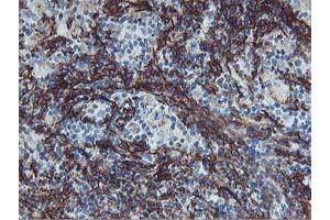 Immunohistochemical staining of paraffin-embedded Human lymphoma tissue using anti-VCAM1 mouse monoclonal antibody.