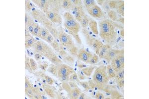 Immunohistochemistry of paraffin-embedded human liver cancer using BLVRB antibody. (BLVRB 抗体)