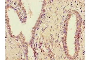 Immunohistochemistry of paraffin-embedded human prostate cancer using ABIN7164562 at dilution of 1:100 (ZDHHC1 抗体  (AA 283-389))