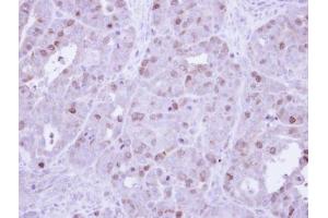 IHC-P Image Immunohistochemical analysis of paraffin-embedded NCIN87 Xenograft, using cyclin A , antibody at 1:500 dilution. (Cyclin A 抗体)