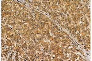ABIN6264901 and ABIN6272886 at 1/100 staining Human breast cancer by IHC-P. (S100A14 抗体  (N-Term))