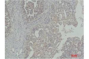 Immunohistochemistry (IHC) analysis of paraffin-embedded Human Ovarian Carcinoma using Stat5a Polyclonal Antibody. (STAT5A 抗体)